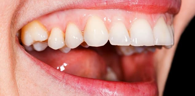 Why Are My Teeth Yellow Near the Gums?