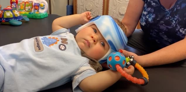 Why Do Down Syndrome Babies Wear Helmets?